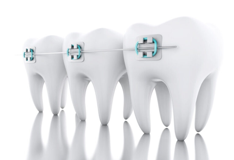 Your Teeth Spacing Guide When to Consider Orthodontic Solutions Orthodontic Treatment in