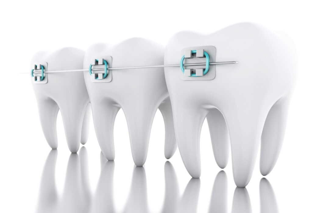 3d,Illustration.,Tooth,With,Braces.,Dental,Care,Concept.,Isolated,White
