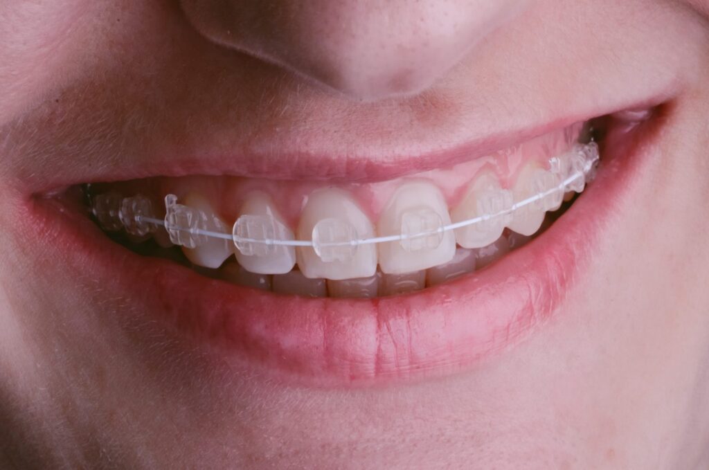 traditional-braces